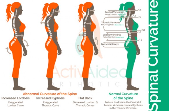 Curvature of the Spine Image - ActivAided