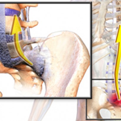 ankylosing spondylitis