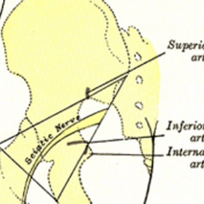 risk factors for sciatica